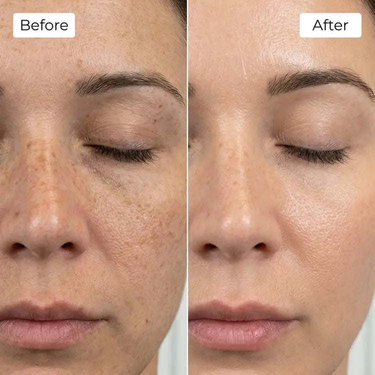 Rejuvena Dermal One - Advanced LED Light Therapy