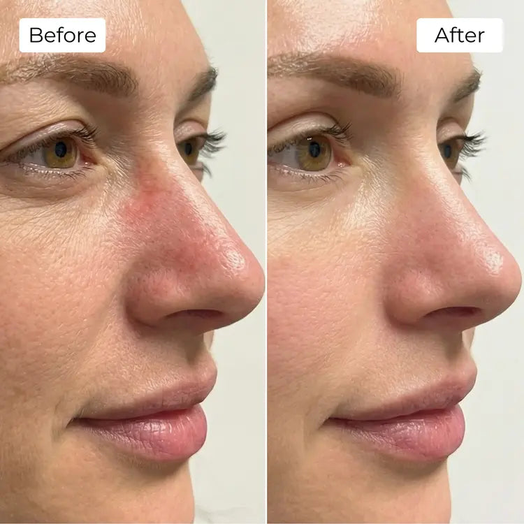 Rejuvena Dermal One - Advanced LED Light Therapy