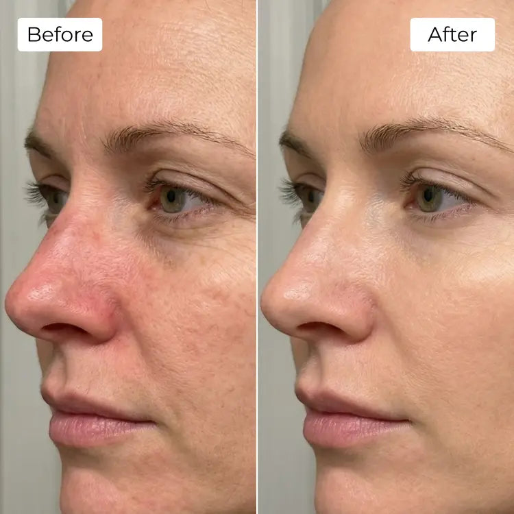 Rejuvena Dermal One - Advanced LED Light Therapy